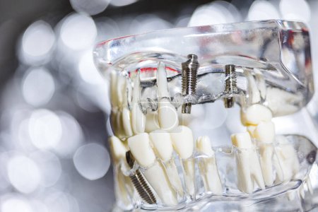 Téléchargez les photos : Modèle de prothèse dentaire en titane pour implants dentaires. Dof peu profond - en image libre de droit