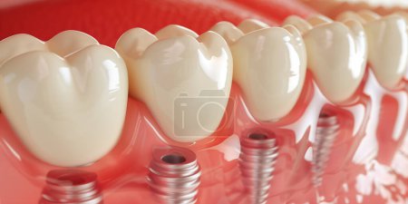 Close up of dental teeth implant. Medically accurate 3D illustration of dental implants concept. 3D rendering
