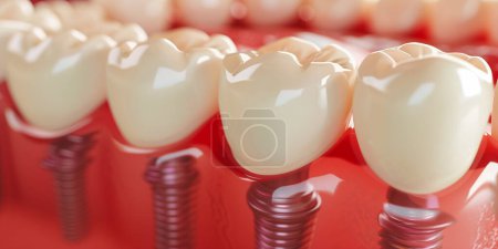 Photo for Close up of dental teeth implant. Medically accurate 3D illustration of dental implants concept. 3D rendering - Royalty Free Image