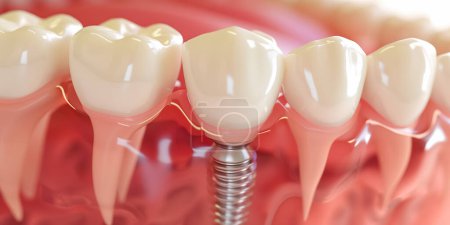 Téléchargez les photos : Gros plan sur l'implant dentaire. Illustration 3D médicalement précise du concept des implants dentaires. rendu 3D - en image libre de droit