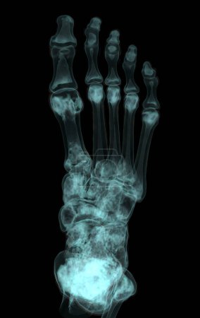 Téléchargez les photos : Rendu 3D des os du pied pour le diagnostic de fracture osseuse et de polyarthrite rhumatoïde à partir du scanner CT. - en image libre de droit