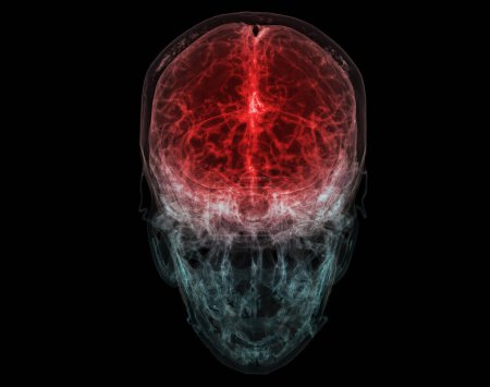 Foto de Ilustración médicamente precisa de la arteria cerebral de la cabeza en 3D - Imagen libre de derechos