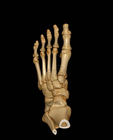 Representación 3D de los huesos del pie para el diagnóstico de fractura ósea y artritis reumatoide mediante tomografía computarizada.