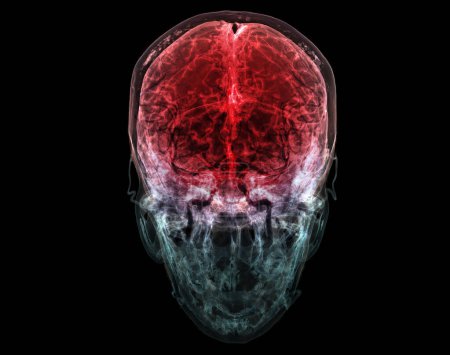 Foto de Ilustración médicamente precisa de la arteria cerebral de la cabeza en 3D - Imagen libre de derechos