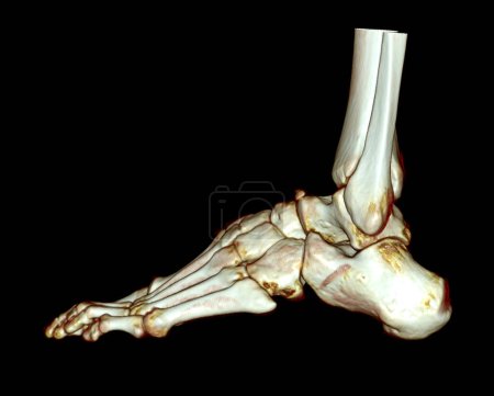 Foto de Representación 3D de los huesos del pie para el diagnóstico de fractura ósea y artritis reumatoide mediante tomografía computarizada. - Imagen libre de derechos