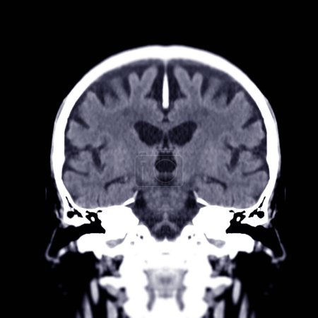 Foto de Tomografía computarizada del cerebro Vista coronal para el diagnóstico de tumores cerebrales, derrames cerebrales y enfermedades vasculares. - Imagen libre de derechos