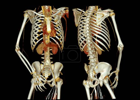 Foto de CTA aorta entera y arteria braquial imagen de renderizado 3D en caso de paciente tramático. - Imagen libre de derechos