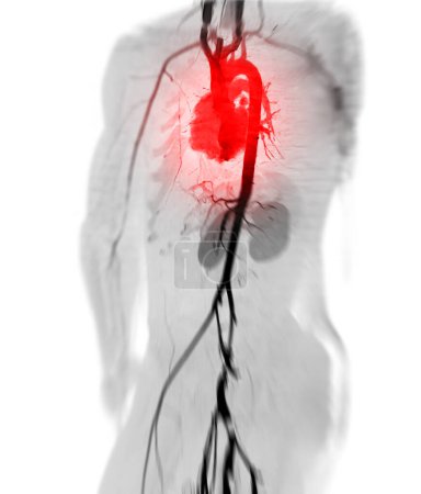Foto de CTA aorta entera y arteria braquial imagen de renderizado 3D en caso de paciente tramático. - Imagen libre de derechos