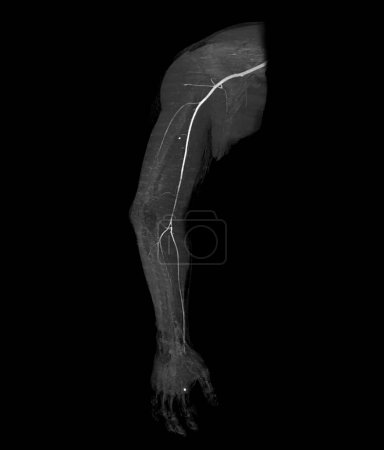 Téléchargez les photos : CTA artère brachiale ou scan CT de l'image de rendu 3D du membre supérieur . - en image libre de droit