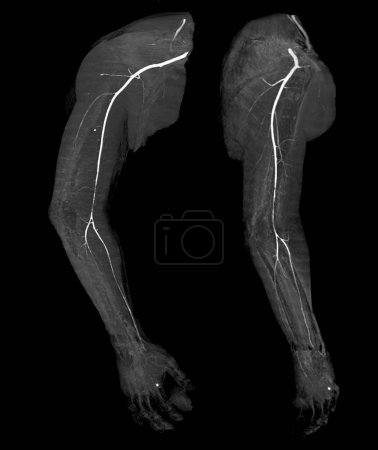 Foto de TAC de arteria braquial o tomografía computarizada de la extremidad superior Imagen de representación 3D . - Imagen libre de derechos