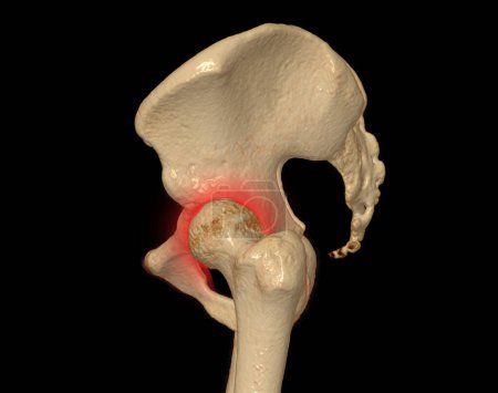 Photo for CT scan of Pelvic bone and hip joint 3D rendering for diagnosis fracture of Pelvic bone and hip joint isolated on black background. - Royalty Free Image