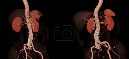 Foto de La ATC aorta completa con injerto de stent de aorta abdominal compara la imagen de renderizado 3D en caso de aneurismas aórticos abdominales. - Imagen libre de derechos