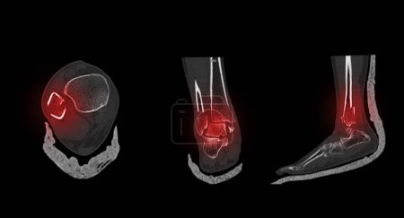 Photo for CT Scan ankle and foot or Computed Tomography of Ankle joint and Foot 3Drendering image showing fractured Tibia and fibula bone. - Royalty Free Image