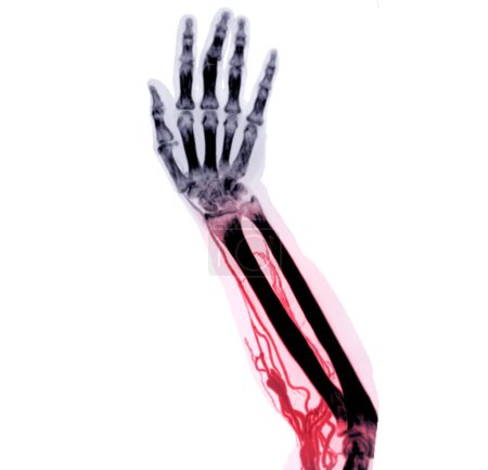 Foto de Arterias braquiales del brazo con representación 3D del hueso de la extremidad superior del escáner CT. - Imagen libre de derechos