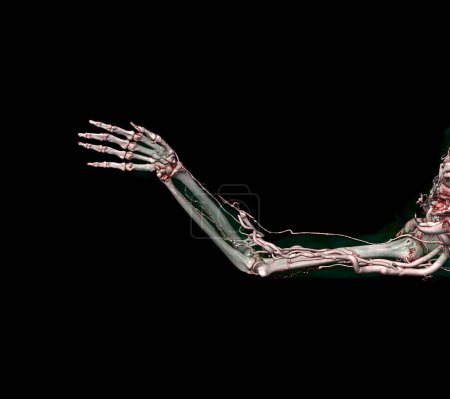 Téléchargez les photos : Artères brachiales du bras avec extrémité supérieure rendu 3D osseux du scanner CT. - en image libre de droit