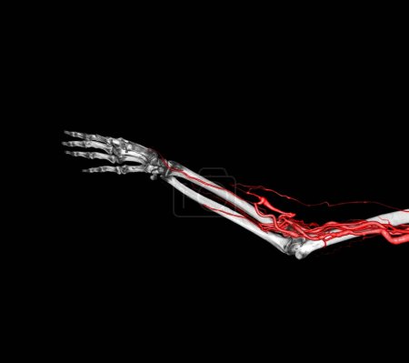Foto de Arterias braquiales del brazo con representación 3D del hueso de la extremidad superior del escáner CT. - Imagen libre de derechos