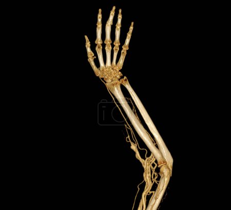 Photo for Brachial Arteries of the arm with Upper extremity Bone 3D rendering from CT Scanner. - Royalty Free Image