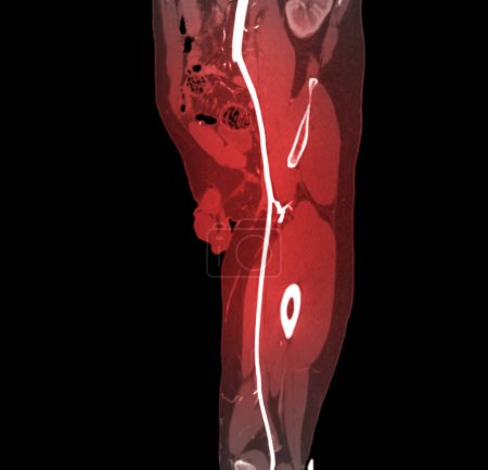 Photo for CTA femoral artery run off image of femoral artery for diagnostic  Acute or Chronic Peripheral Arterial Disease. - Royalty Free Image