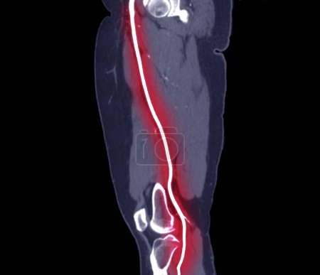 Photo for CTA femoral artery run off image of femoral artery for diagnostic  Acute or Chronic Peripheral Arterial Disease. - Royalty Free Image