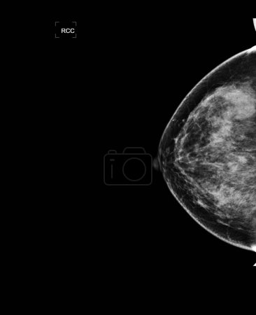 Téléchargez les photos : La mammographie numérique à rayons X ou la mammographie des deux côtés du sein montrant une tumeur bénigne BI-RADS 3 doit être vérifiée une fois par an. - en image libre de droit