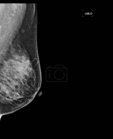 Photo for X-ray Digital Mammogram or mammography of both side breast showing benign tumor BI-RADS 3 should be checked once a year. - Royalty Free Image