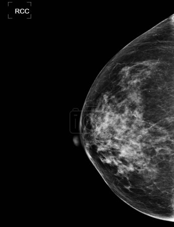 Téléchargez les photos : La mammographie numérique à rayons X ou la mammographie des deux côtés du sein montrant une tumeur bénigne BI-RADS 2 doit être vérifiée une fois par an. - en image libre de droit