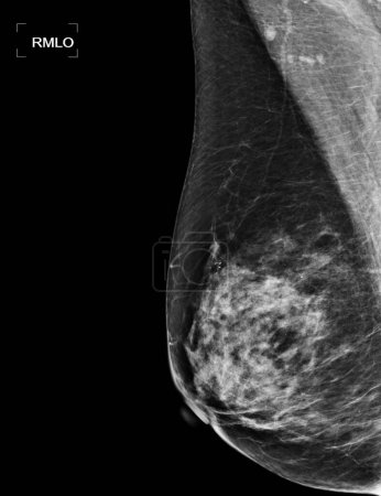 Photo for X-ray Digital Mammogram or mammography of both side breast showing benign tumor BI-RADS 2 should be checked once a year. - Royalty Free Image