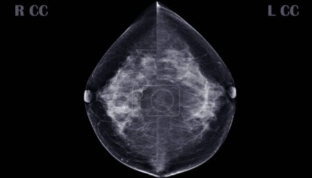 Photo for X-ray Digital Mammogram or mammography of both side breast CC view showing benign tumor BI-RADS 2 should be checked once a year. - Royalty Free Image