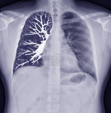 Foto de Fusion image of Chest x-ray and CT Chest  Coronal view  for lung infection from covid-19 Concept. - Imagen libre de derechos
