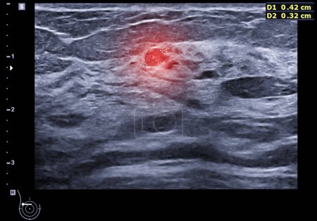 Foto de Ultrasound  breast of Patient after mammogram  for diagnonsis Breast cancer in women isolated on black background. - Imagen libre de derechos