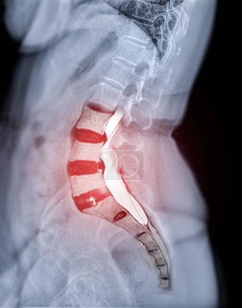 Foto de Imagen de rayos X de la columna lumbar o de la columna L-s vista lateral con la columna L-s de la RM para el diagnóstico del dolor lumbar. - Imagen libre de derechos