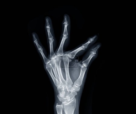 Foto de Película de rayos X ambas manos AP ver muestran manos humanas aisladas sobre fondo negro . - Imagen libre de derechos
