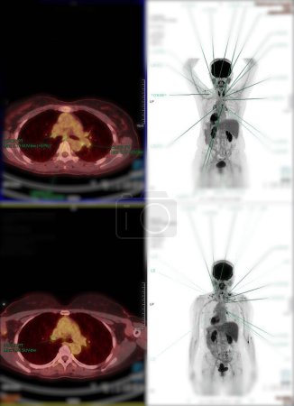 Photo for Positron emission tomography (PET) CT scan uses a radioactive drug (tracer) to show both normal and abnormal metabolic activity of Whole  human body  for detect cancer recurrence after surgery . - Royalty Free Image
