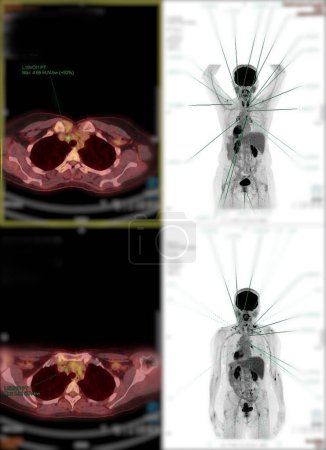 Photo for Positron emission tomography (PET) CT scan uses a radioactive drug (tracer) to show both normal and abnormal metabolic activity of Whole  human body  for detect cancer recurrence after surgery . - Royalty Free Image