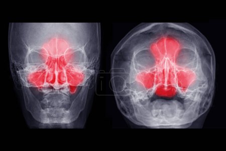 Photo for X-ray image of paranasal sinuses Ap and water's view for diagnosis sinusitis. - Royalty Free Image