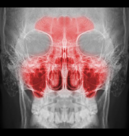 Photo for X-ray image of paranasal sinuses for diagnosis sinusitis. - Royalty Free Image