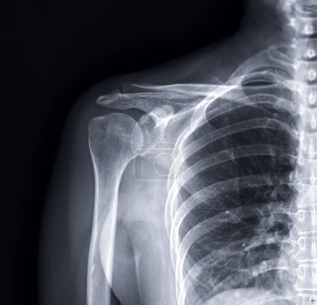 Téléchargez les photos : X-ray Shoulder joint shoulder front view for diagnosis fracture of shoulder joint. - en image libre de droit