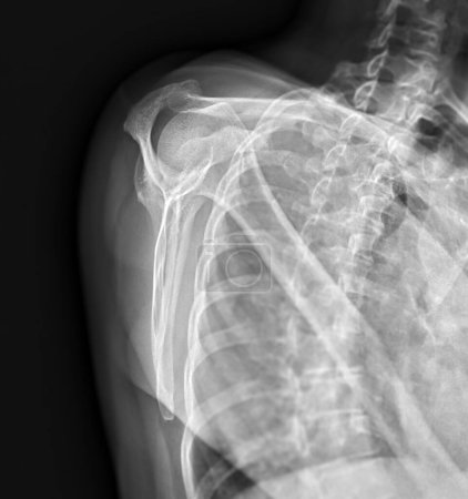 Téléchargez les photos : X-ray Shoulder joint shoulder transcapular view for diagnosis fracture of shoulder joint. - en image libre de droit