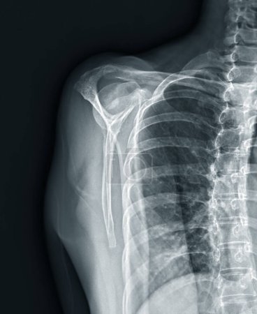 Téléchargez les photos : X-ray Shoulder joint shoulder transcapular view for diagnosis fracture of shoulder joint. - en image libre de droit
