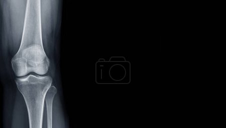 Foto de Film x-ray  of Left knee joint  AP view  for medical background. - Imagen libre de derechos