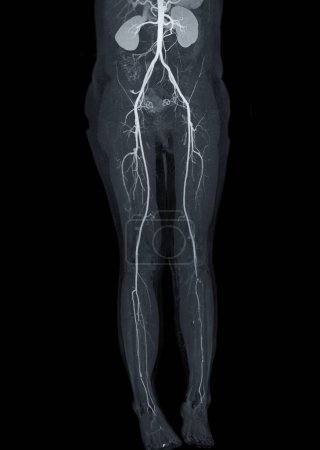 Foto de CTA arteria femoral que muestra arteria femoral para diagnóstico Enfermedad arterial periférica aguda o crónica. - Imagen libre de derechos