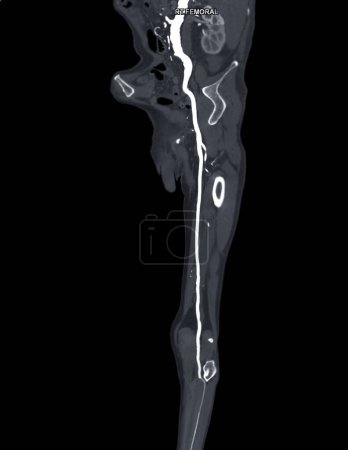 Foto de CTA arteria femoral se ejecuta fuera de la curva MPR que muestra la arteria femoral izquierda para el diagnóstico Enfermedad arterial periférica aguda o crónica. - Imagen libre de derechos