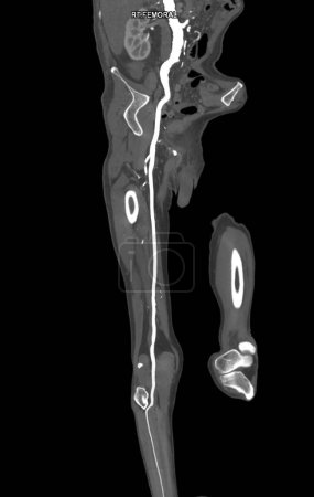 Photo for CTA femoral artery run  off MPR curve  showing Right  femoral artery for diagnostic  Acute or Chronic Peripheral Arterial Disease. - Royalty Free Image