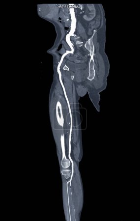 Foto de CTA arteria femoral fuera de curva MPR que muestra arteria femoral derecha para el diagnóstico Enfermedad arterial periférica aguda o crónica. - Imagen libre de derechos