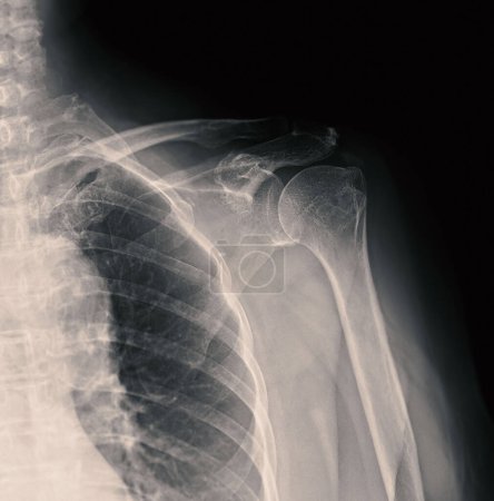 Téléchargez les photos : X-ray Shoulder joint shoulder front view for diagnosis fracture of shoulder joint. - en image libre de droit