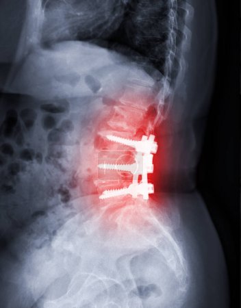 Téléchargez les photos : Image radiographique de la colonne vertébrale lombaire montrant une fixation par vis pédiculaire et une chirurgie de décompression chez un patient atteint de sténose du canal rachidien. - en image libre de droit