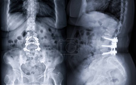 Téléchargez les photos : Image radiographique de la colonne vertébrale lombaire montrant une fixation par vis pédiculaire et une chirurgie de décompression chez un patient atteint de sténose du canal rachidien. - en image libre de droit