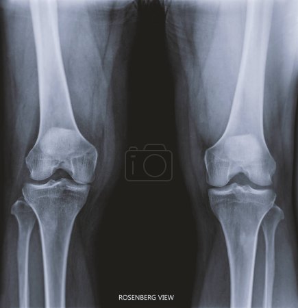 Foto de Film x-ray  both knee joint  AP view name is Rosenberg view  for diagnosis knee pain from osteoarthritis knee  and fracture . - Imagen libre de derechos