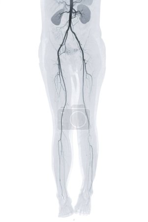Photo for CTA femoral artery run off showing femoral artery  Presenting with Acute or Chronic Peripheral Arterial Disease. - Royalty Free Image
