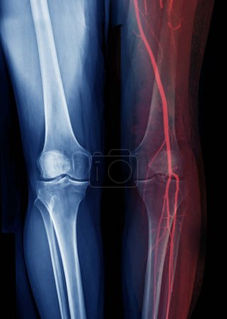 Foto de X-ray image of knee joint Fusion  with CTA Femoral run off . - Imagen libre de derechos